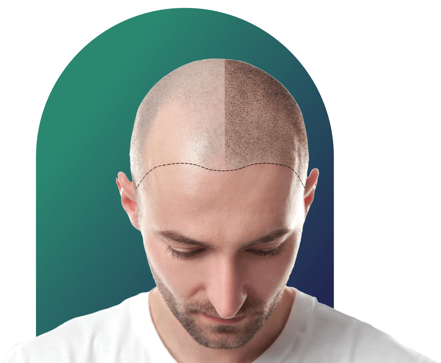 Hair transplant for men